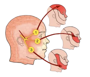 Curar la neuralgia del trigémino con quiropráctica es posible 2